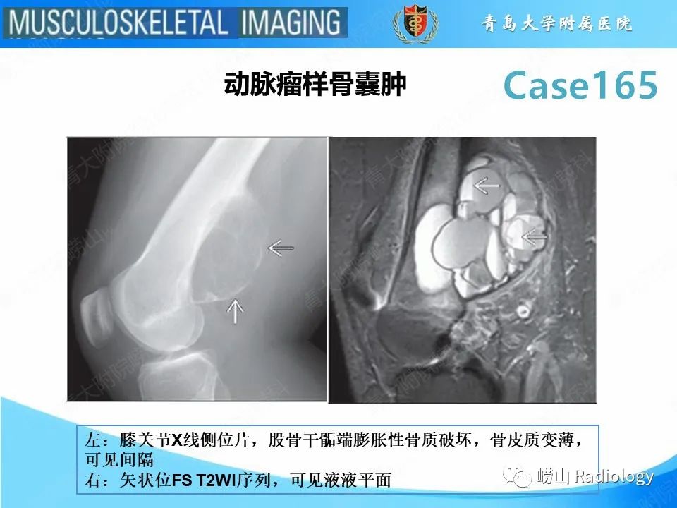 影像PPT - 【PPT】非骨化性纤维瘤-14
