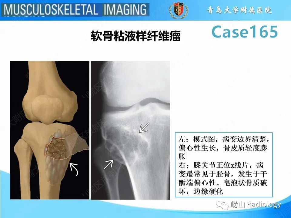 影像PPT - 【PPT】非骨化性纤维瘤-18