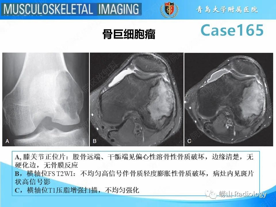影像PPT - 【PPT】非骨化性纤维瘤-16