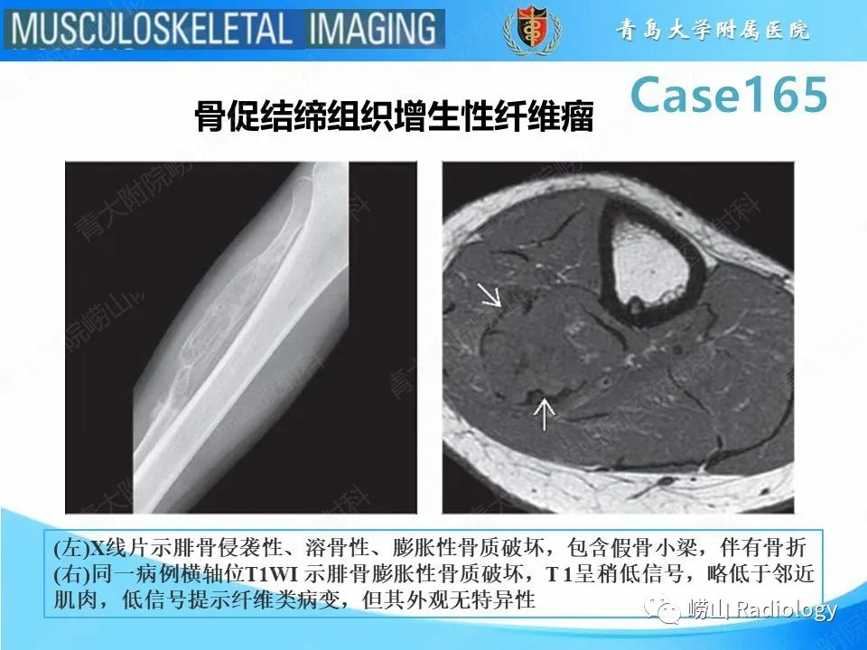 影像PPT - 【PPT】非骨化性纤维瘤-27