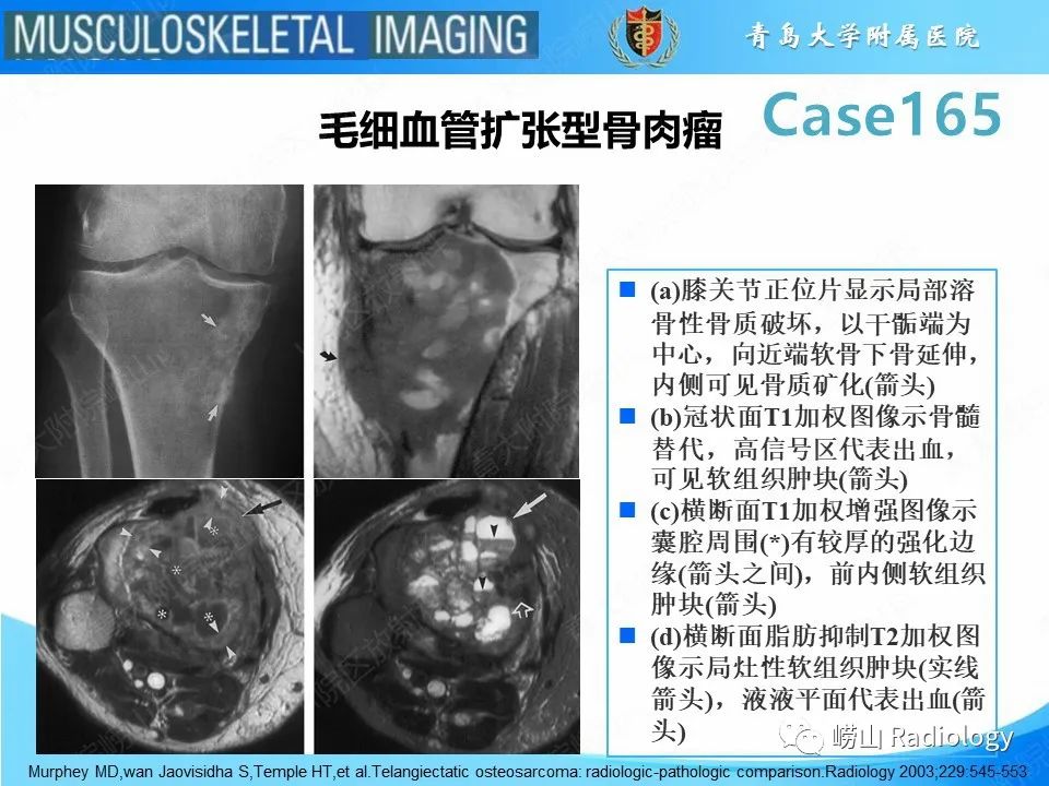 影像PPT - 【PPT】非骨化性纤维瘤-31