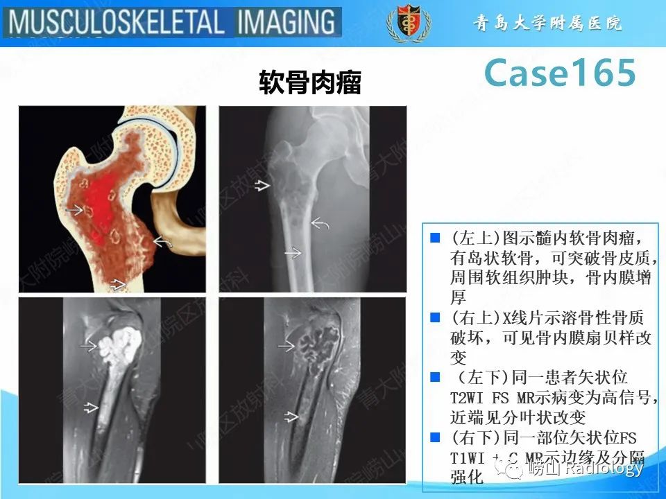 影像PPT - 【PPT】非骨化性纤维瘤-29