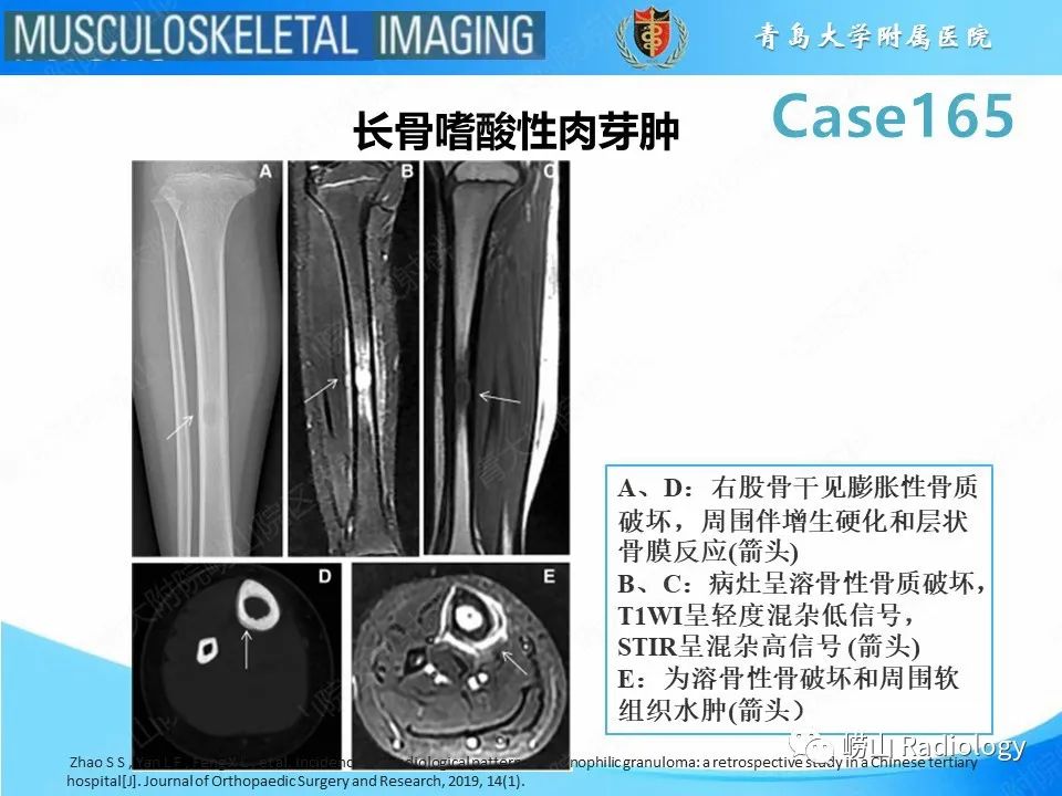 影像PPT - 【PPT】非骨化性纤维瘤-33