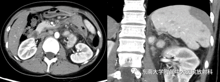 影像PPT - 【PPT】腹膜后Castleman病-2