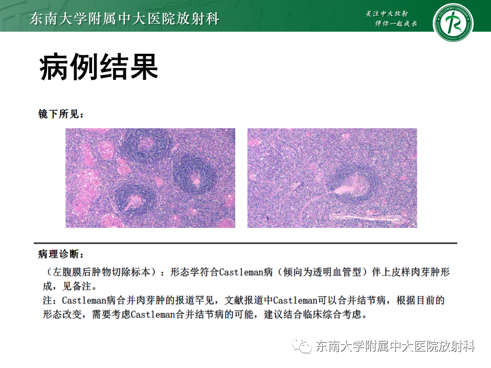 影像PPT - 【PPT】腹膜后Castleman病-3