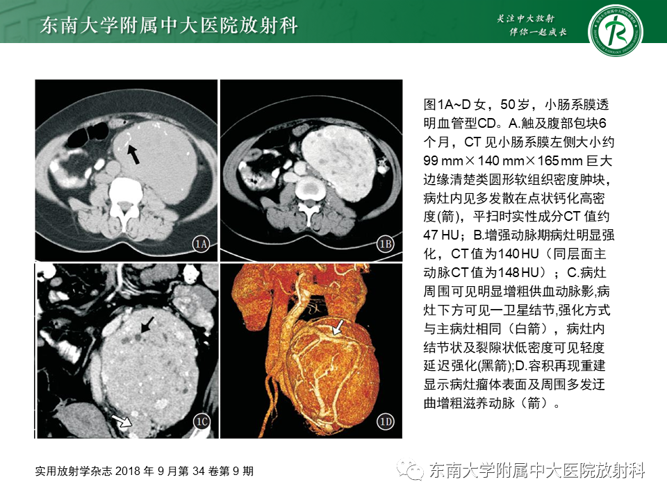 影像PPT - 【PPT】腹膜后Castleman病-11