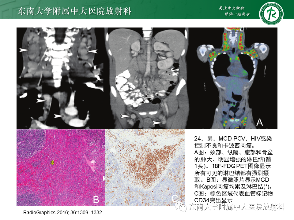 影像PPT - 【PPT】腹膜后Castleman病-12