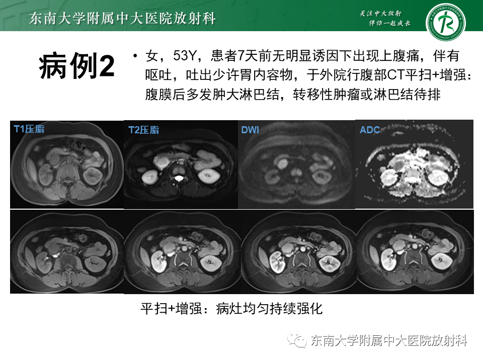 影像PPT - 【PPT】腹膜后Castleman病-13