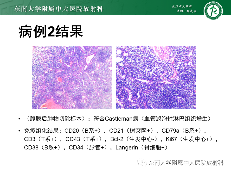 影像PPT - 【PPT】腹膜后Castleman病-14