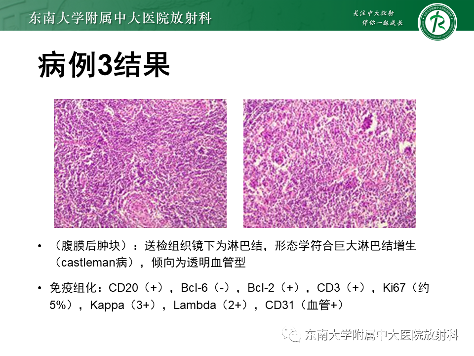 影像PPT - 【PPT】腹膜后Castleman病-16