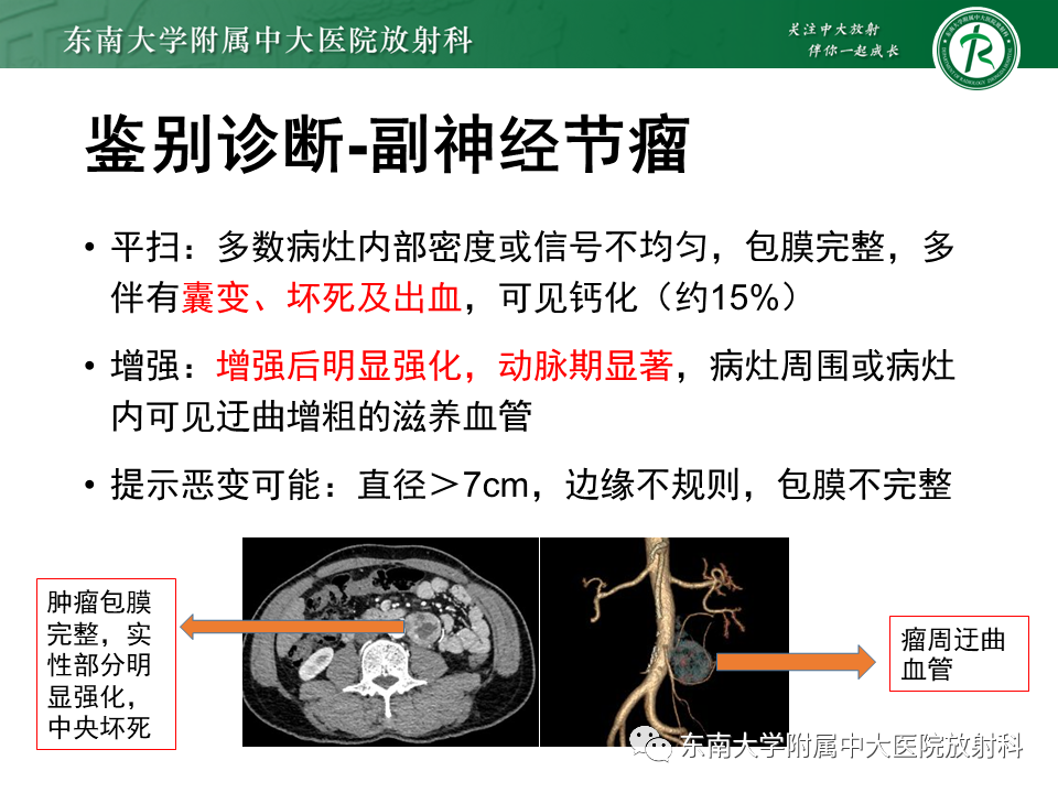 影像PPT - 【PPT】腹膜后Castleman病-18