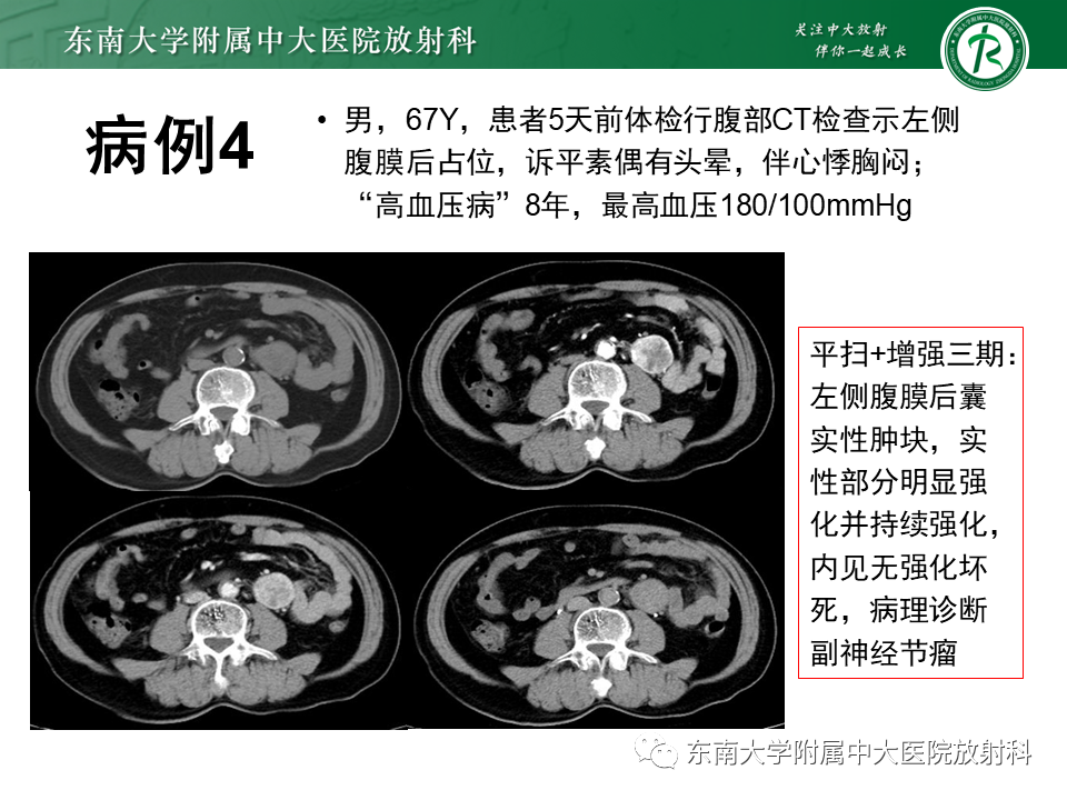 影像PPT - 【PPT】腹膜后Castleman病-19