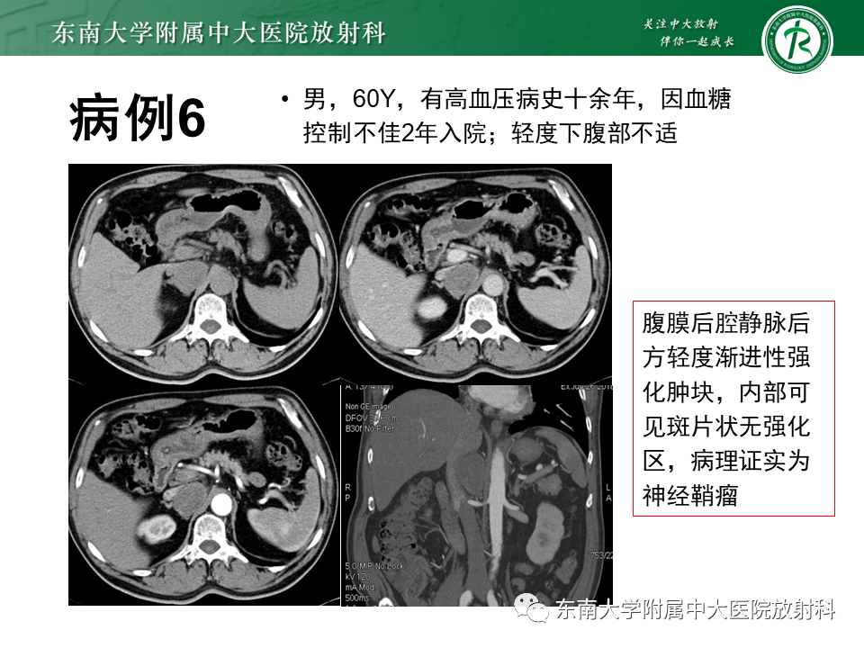 影像PPT - 【PPT】腹膜后Castleman病-23