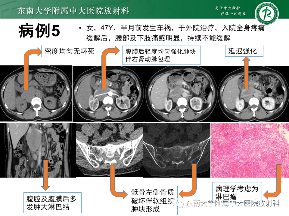 影像PPT - 【PPT】腹膜后Castleman病-21