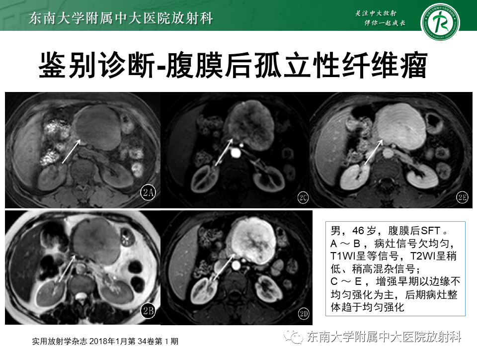 影像PPT - 【PPT】腹膜后Castleman病-25