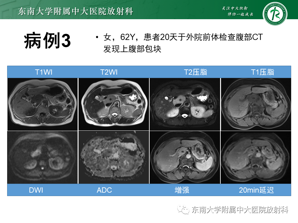影像PPT - 【PPT】腹膜后Castleman病-1