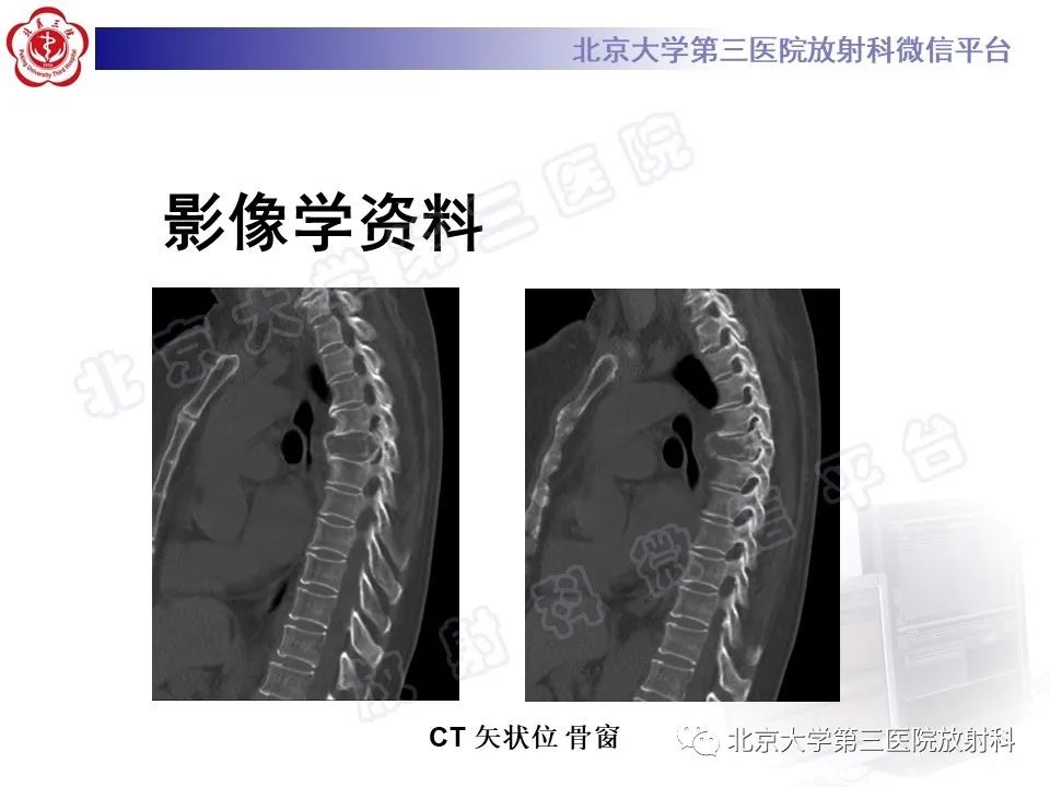 影像PPT - 【PPT】脊柱上皮样血管内皮瘤-4