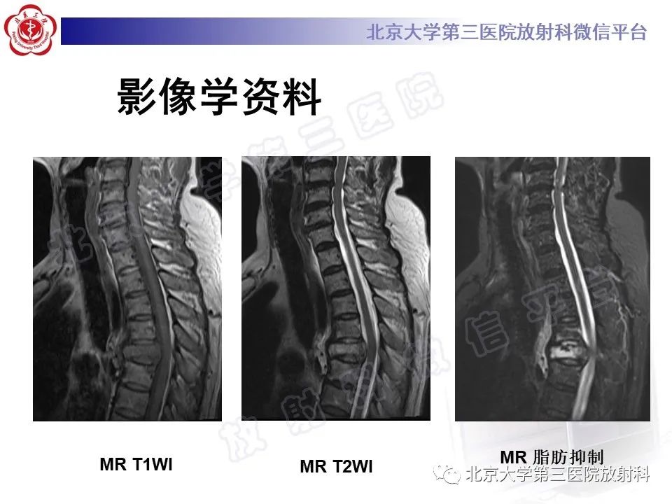 影像PPT - 【PPT】脊柱上皮样血管内皮瘤-5