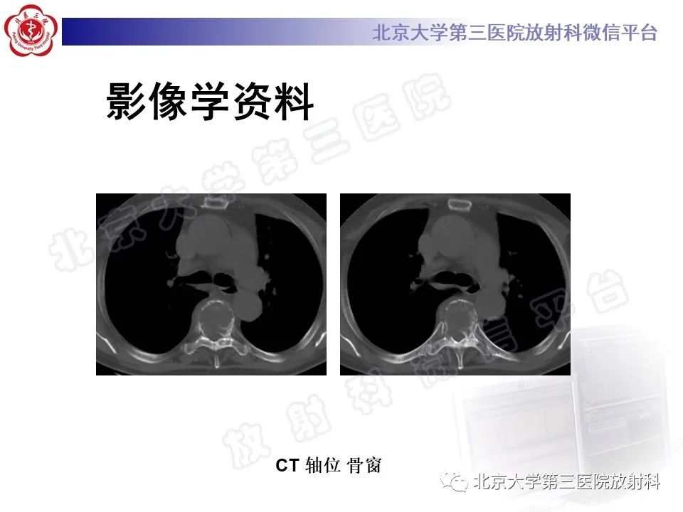 影像PPT - 【PPT】脊柱上皮样血管内皮瘤-3