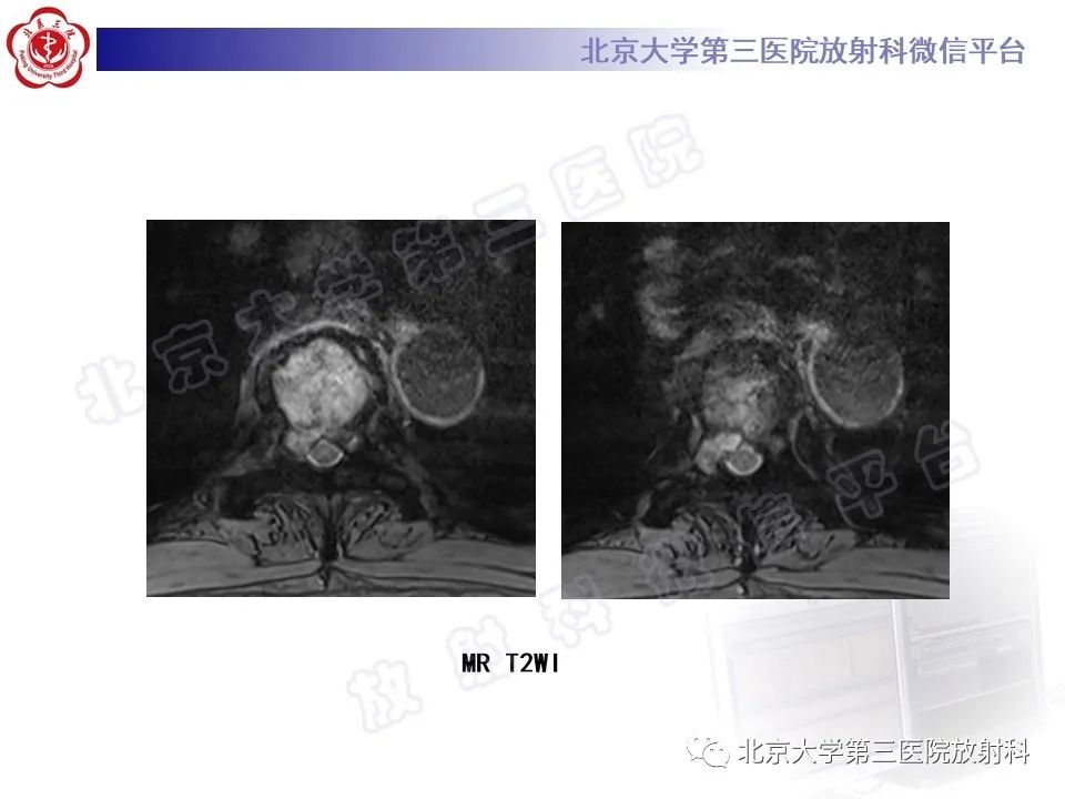 影像PPT - 【PPT】脊柱上皮样血管内皮瘤-6