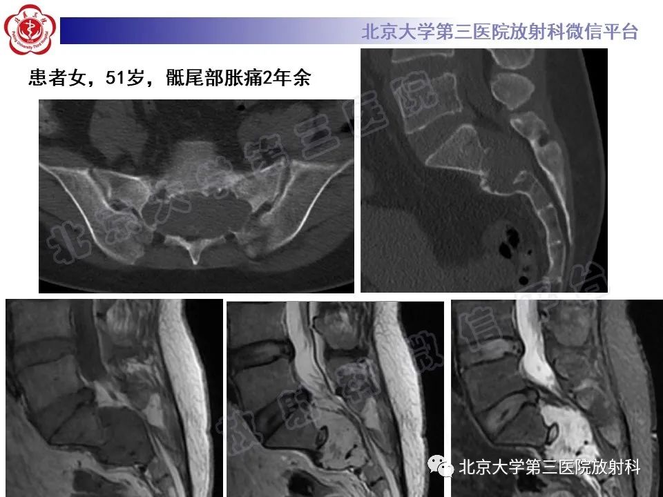 影像PPT - 【PPT】脊柱上皮样血管内皮瘤-19