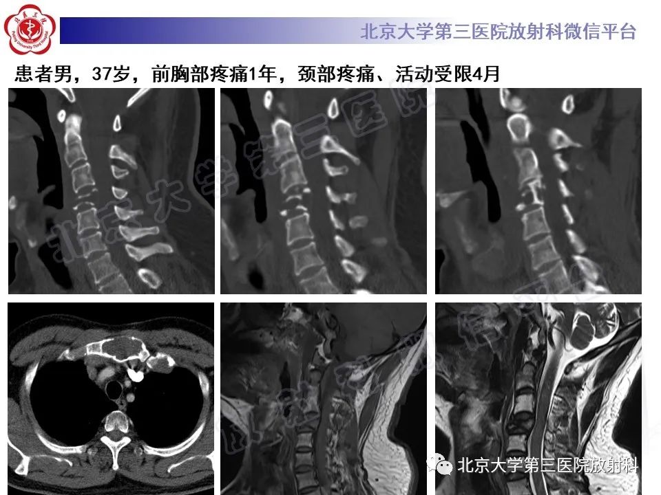 影像PPT - 【PPT】脊柱上皮样血管内皮瘤-20