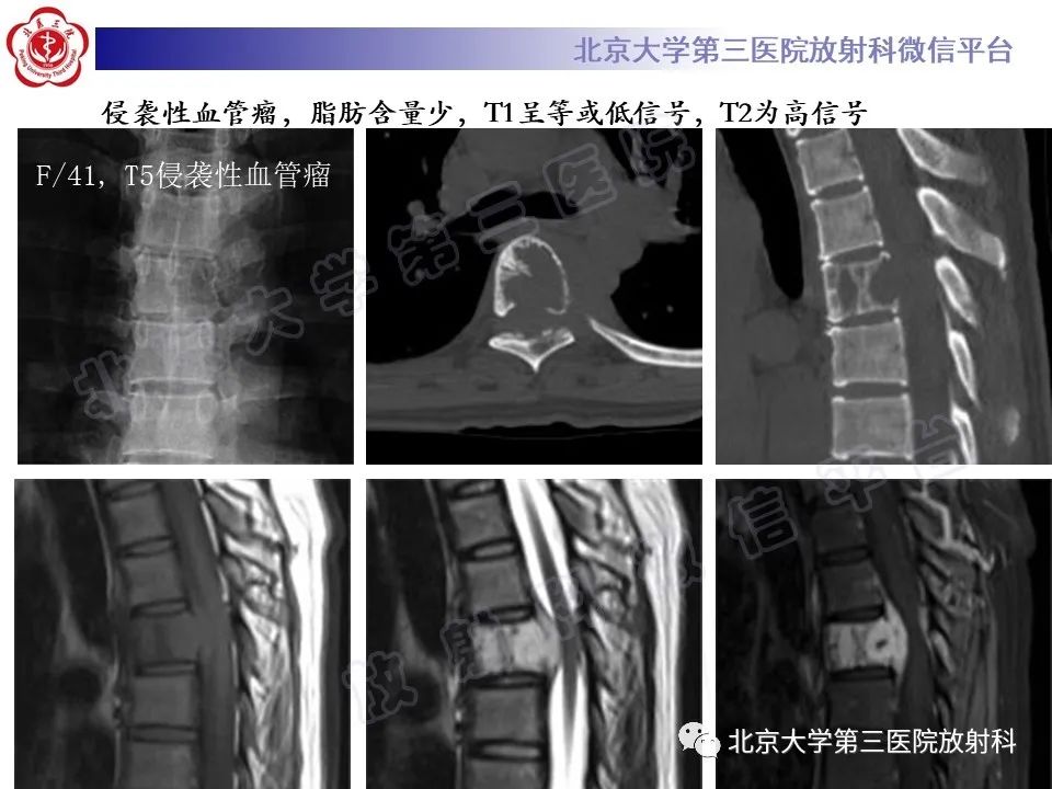影像PPT - 【PPT】脊柱上皮样血管内皮瘤-24