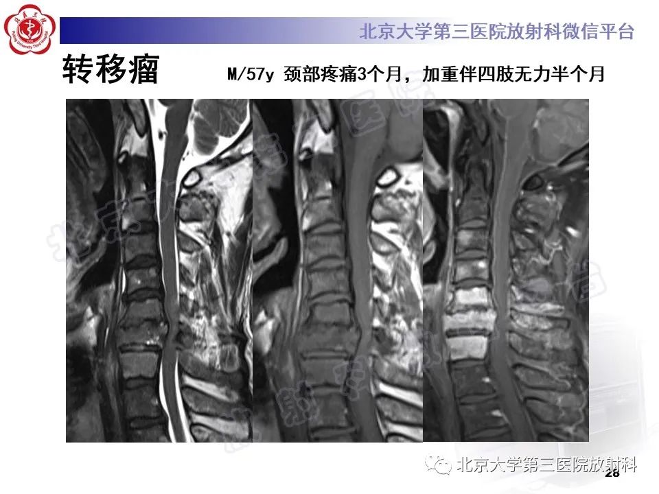 影像PPT - 【PPT】脊柱上皮样血管内皮瘤-27
