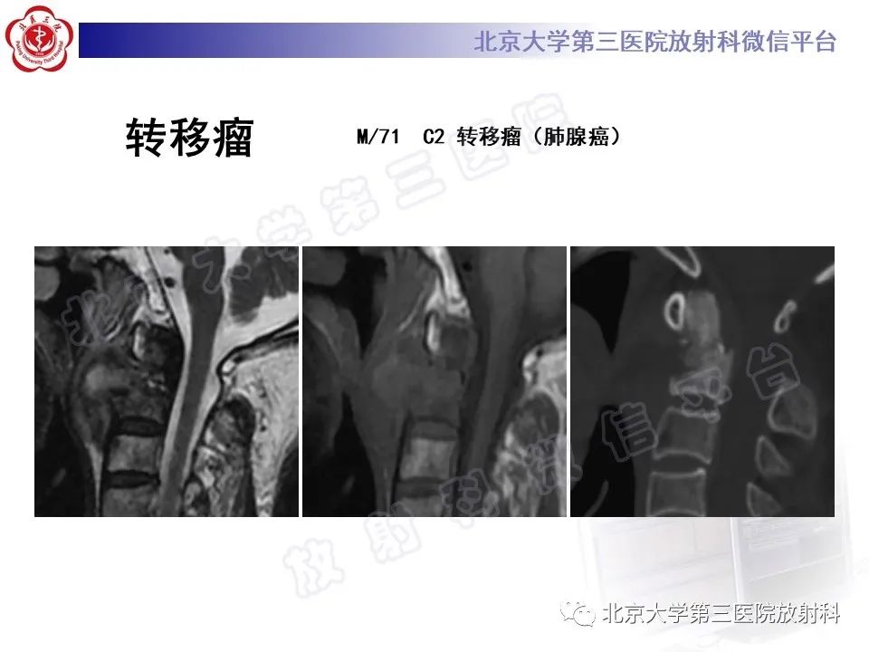 影像PPT - 【PPT】脊柱上皮样血管内皮瘤-28
