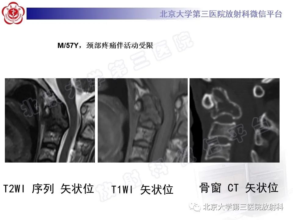 影像PPT - 【PPT】脊柱上皮样血管内皮瘤-30