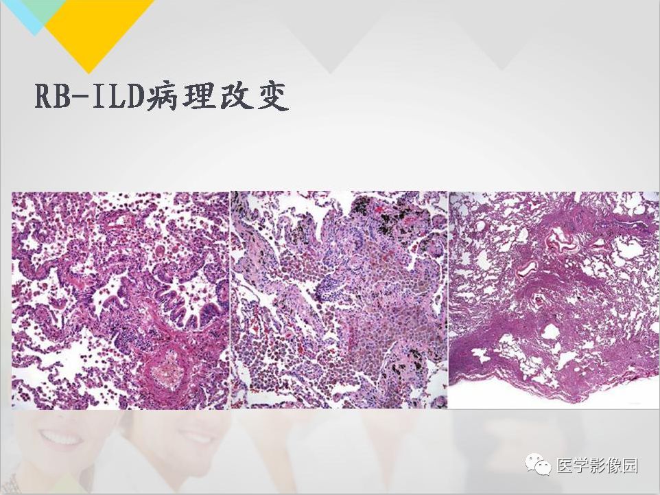 影像PPT - 【PPT】吸烟相关性间质性肺疾病的HRCT诊断-12