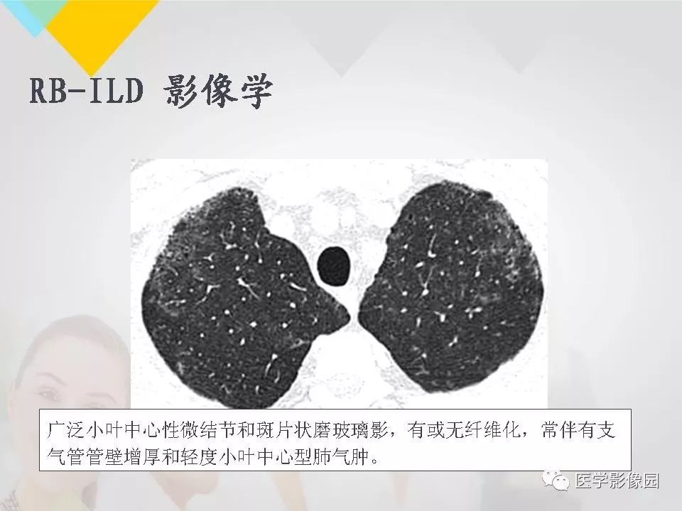 影像PPT - 【PPT】吸烟相关性间质性肺疾病的HRCT诊断-19