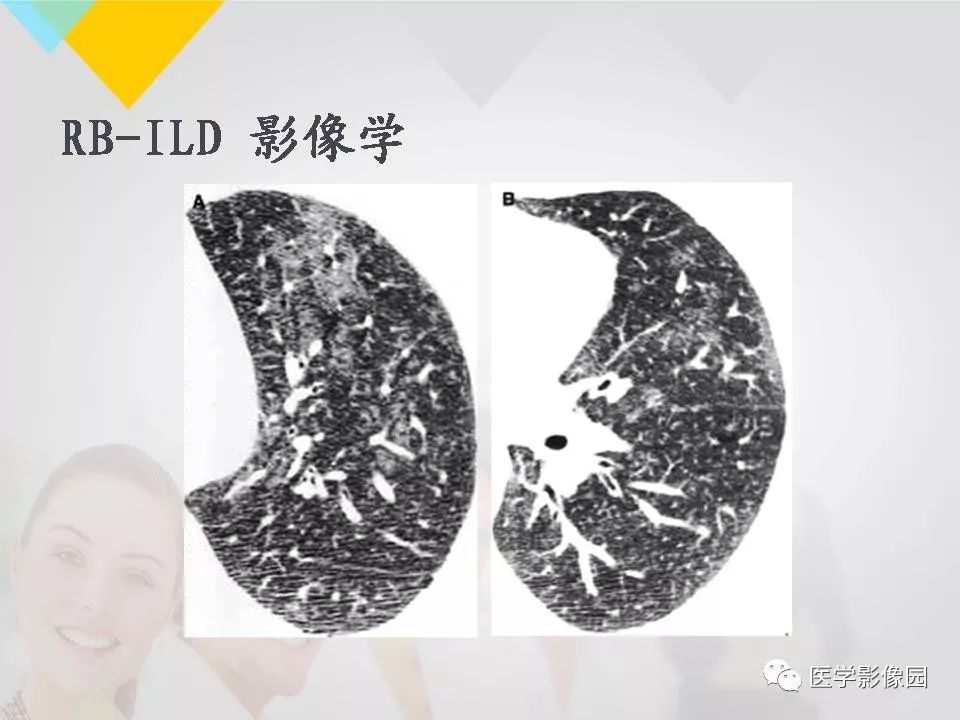 影像PPT - 【PPT】吸烟相关性间质性肺疾病的HRCT诊断-20
