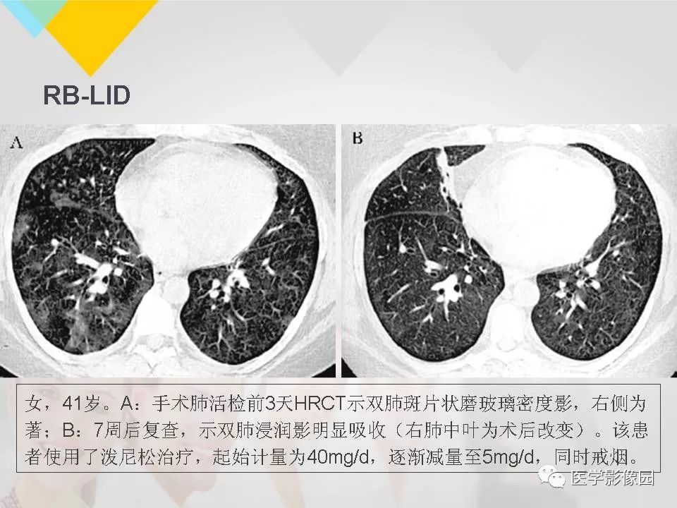 影像PPT - 【PPT】吸烟相关性间质性肺疾病的HRCT诊断-21
