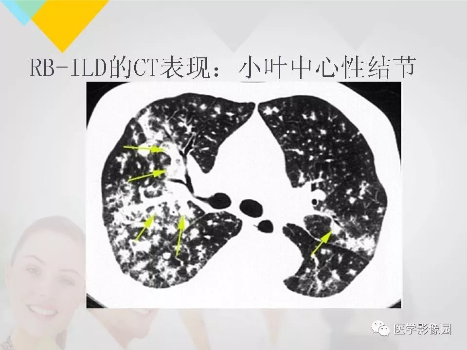 影像PPT - 【PPT】吸烟相关性间质性肺疾病的HRCT诊断-23