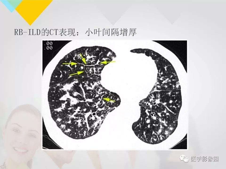 影像PPT - 【PPT】吸烟相关性间质性肺疾病的HRCT诊断-24