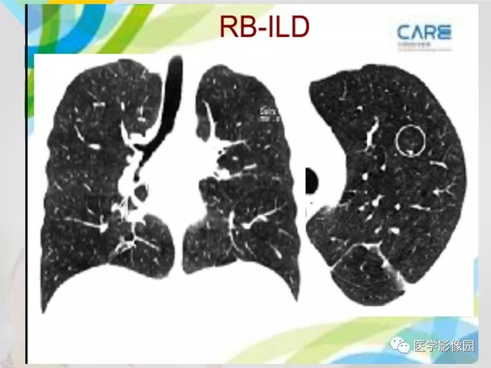 影像PPT - 【PPT】吸烟相关性间质性肺疾病的HRCT诊断-25
