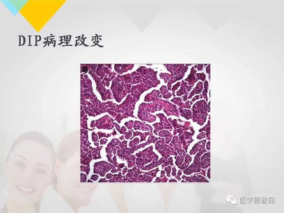 影像PPT - 【PPT】吸烟相关性间质性肺疾病的HRCT诊断-33