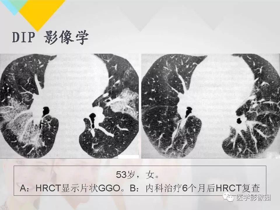 影像PPT - 【PPT】吸烟相关性间质性肺疾病的HRCT诊断-39