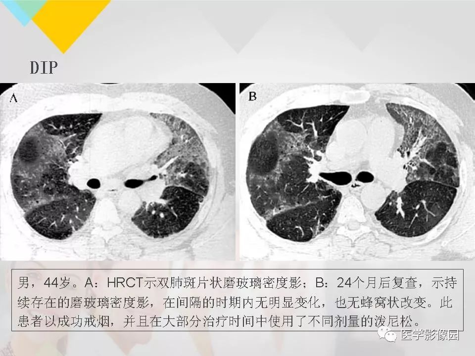 影像PPT - 【PPT】吸烟相关性间质性肺疾病的HRCT诊断-40