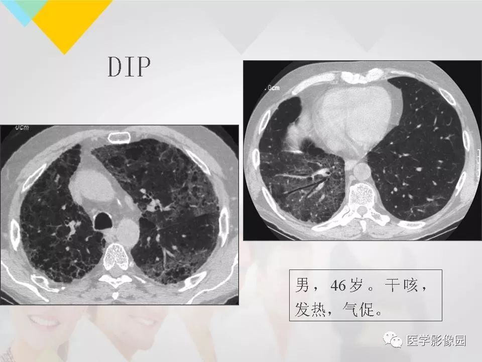 影像PPT - 【PPT】吸烟相关性间质性肺疾病的HRCT诊断-41