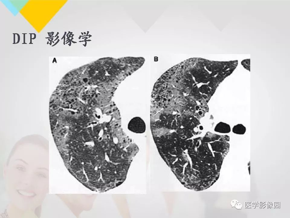 影像PPT - 【PPT】吸烟相关性间质性肺疾病的HRCT诊断-42
