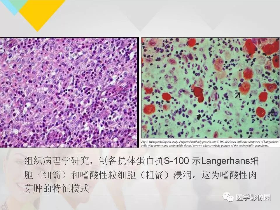 影像PPT - 【PPT】吸烟相关性间质性肺疾病的HRCT诊断-52
