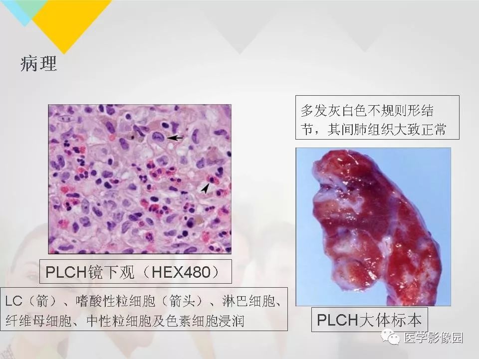 影像PPT - 【PPT】吸烟相关性间质性肺疾病的HRCT诊断-56