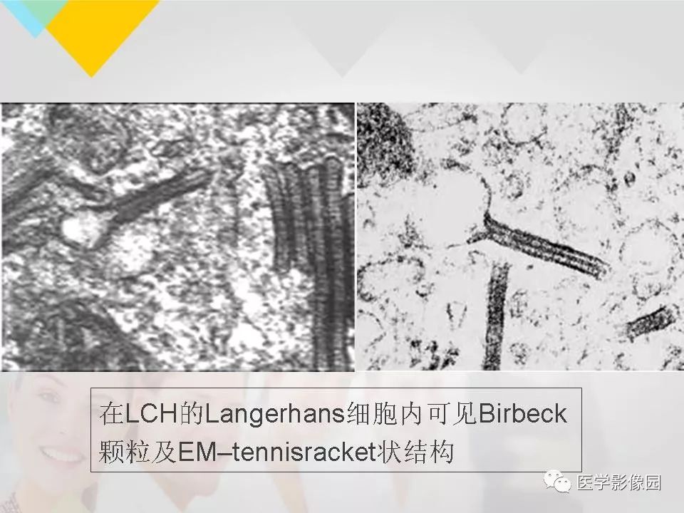影像PPT - 【PPT】吸烟相关性间质性肺疾病的HRCT诊断-54