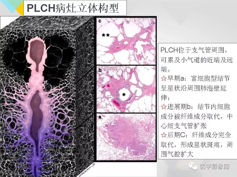 影像PPT - 【PPT】吸烟相关性间质性肺疾病的HRCT诊断-57