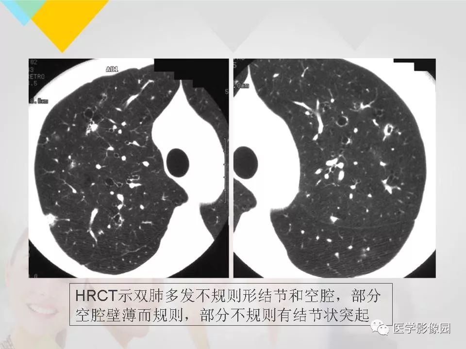 影像PPT - 【PPT】吸烟相关性间质性肺疾病的HRCT诊断-63