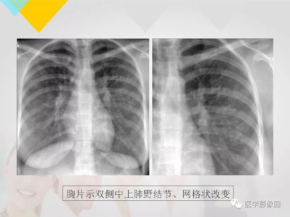 影像PPT - 【PPT】吸烟相关性间质性肺疾病的HRCT诊断-64
