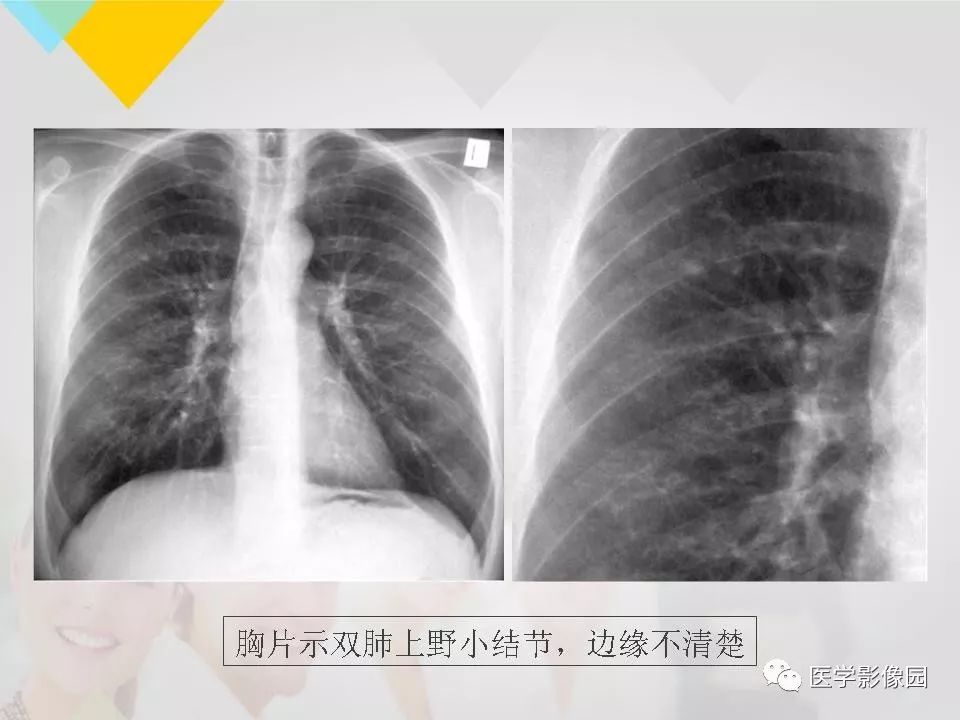 影像PPT - 【PPT】吸烟相关性间质性肺疾病的HRCT诊断-62