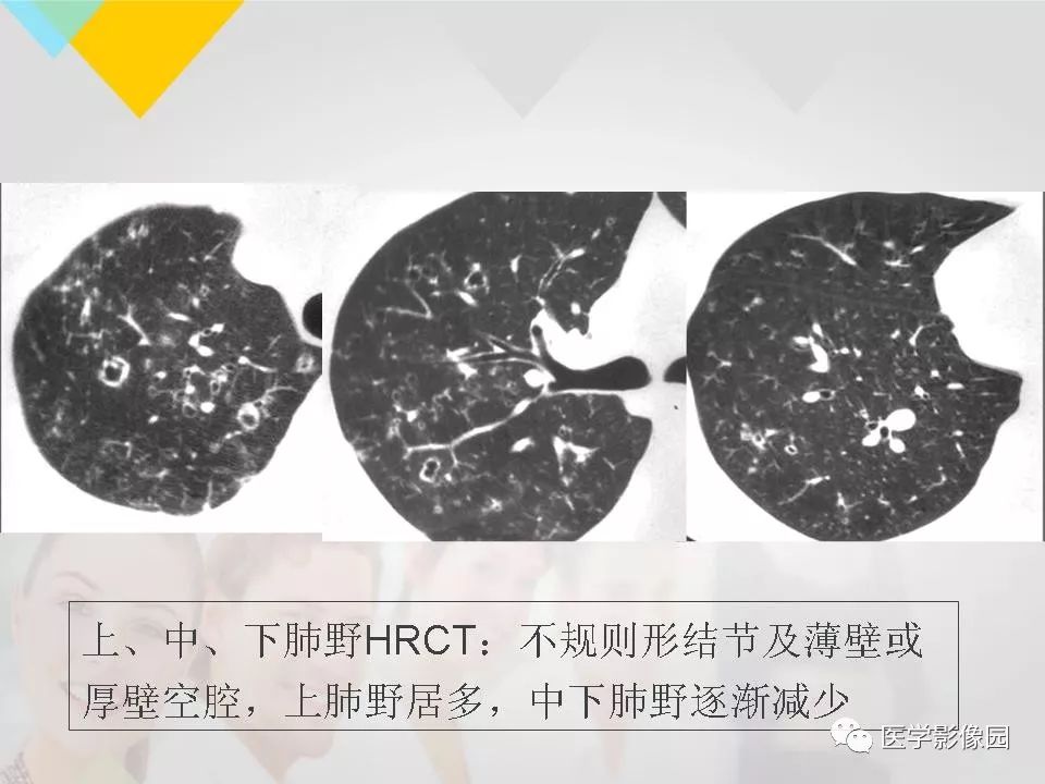影像PPT - 【PPT】吸烟相关性间质性肺疾病的HRCT诊断-65